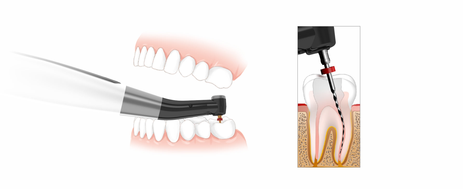 Woodpecker Endomatic Endo Motor With Apex Locator